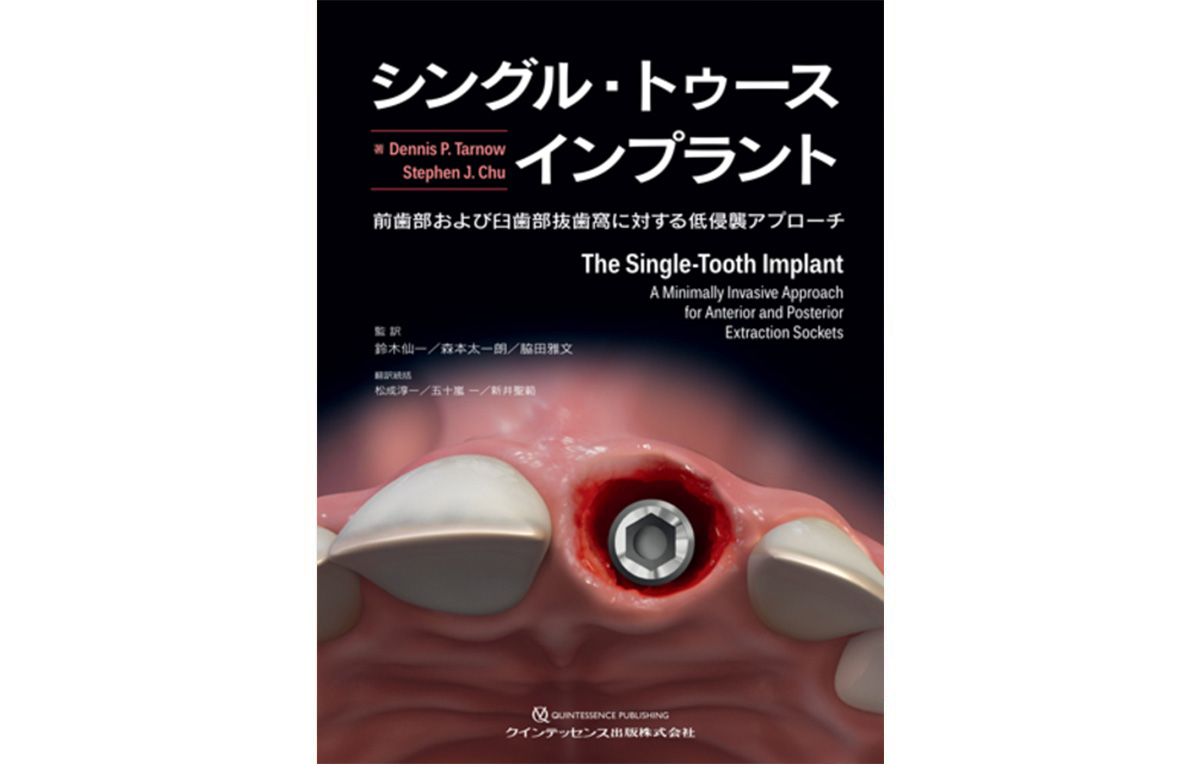 シングル・トゥースインプラント