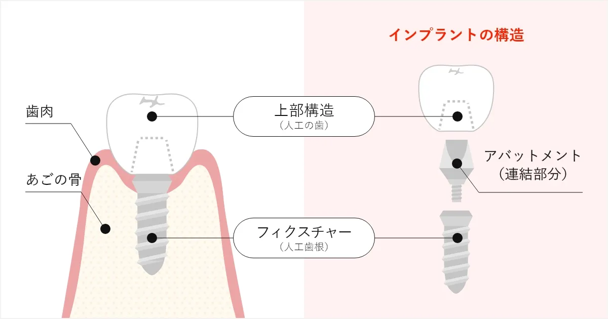 インプラントの基本構造を支える人工歯・インプラント体・アバットメント