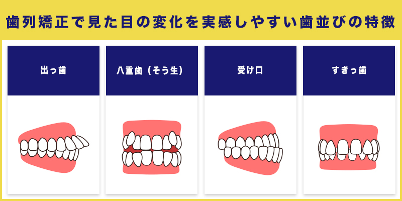 歯列矯正で見た目の変化を実感しやすい歯並びの特徴