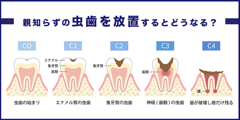 親知らaずの虫歯を放置するとどうなるのか